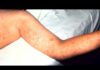 Measles Surge Explodes Past 2025 The CDC says measles cases across the country have reached a 35-year high