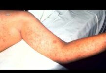 The CDC says measles cases across the country have reached a 35-year high