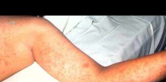 The CDC says measles cases across the country have reached a 35-year high